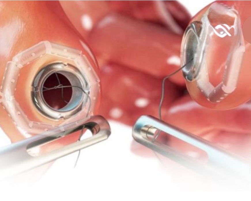 Magnetic Anastomosis